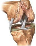 artrose van de knie met toenmende flexiecontractuur
