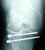 oude, operatief behandelde fractuur van het kniegewricht